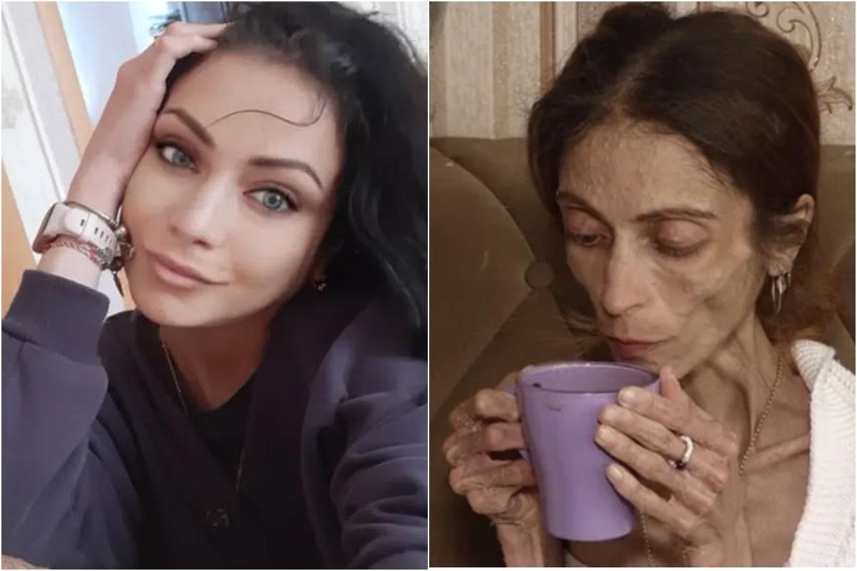 Организм поедал сам себя: как Яна Боброва с весом 20 кг смогла начать жизнь заново